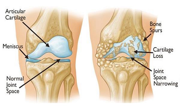 rebuild-your-bones-and-joints