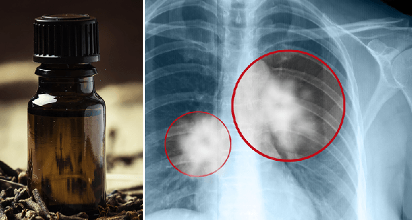 This Oil Stops Cancer Growth