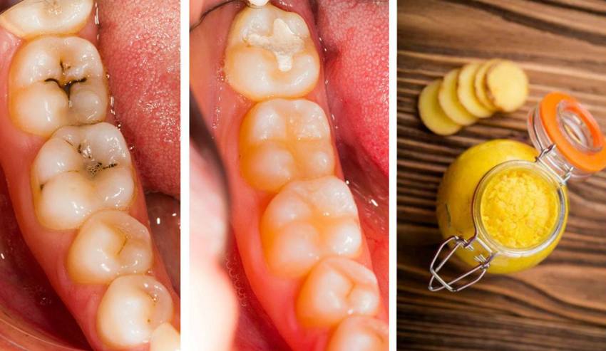 tooth cavities heal decay naturally remedies