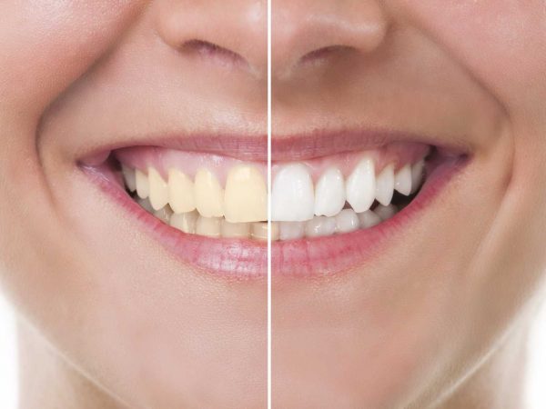 a-dentist-reveals-the-most-effective-way-to-whiten-your-teeth