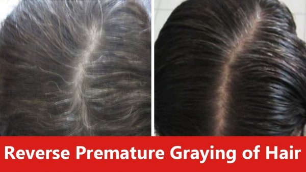 Treatment To Help Eliminate Gray Hair Naturally Without Exposing