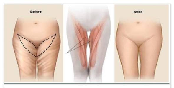 5 Exercises In 6 Minutes For Sexy Thighs(Video)