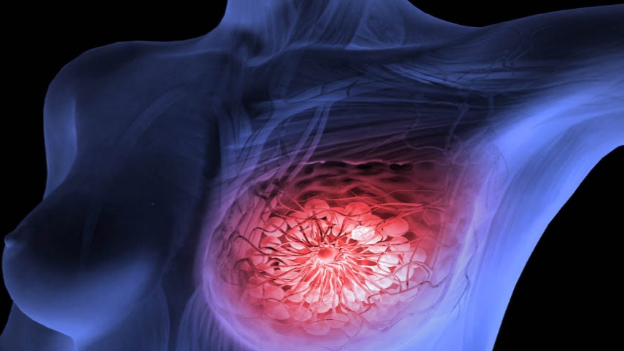 We-Drink-It-Daily-But-Don’t-Know-That-It-Causes-Breast-Cancer